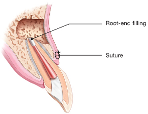 A tooth undergone apicoectomy procedure